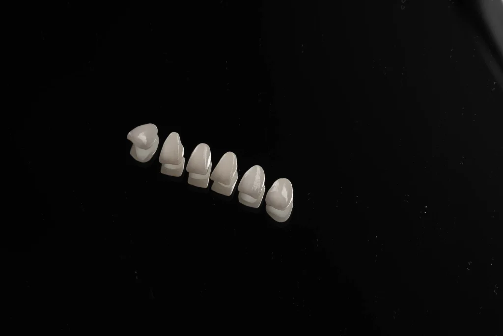 carillas-dentales