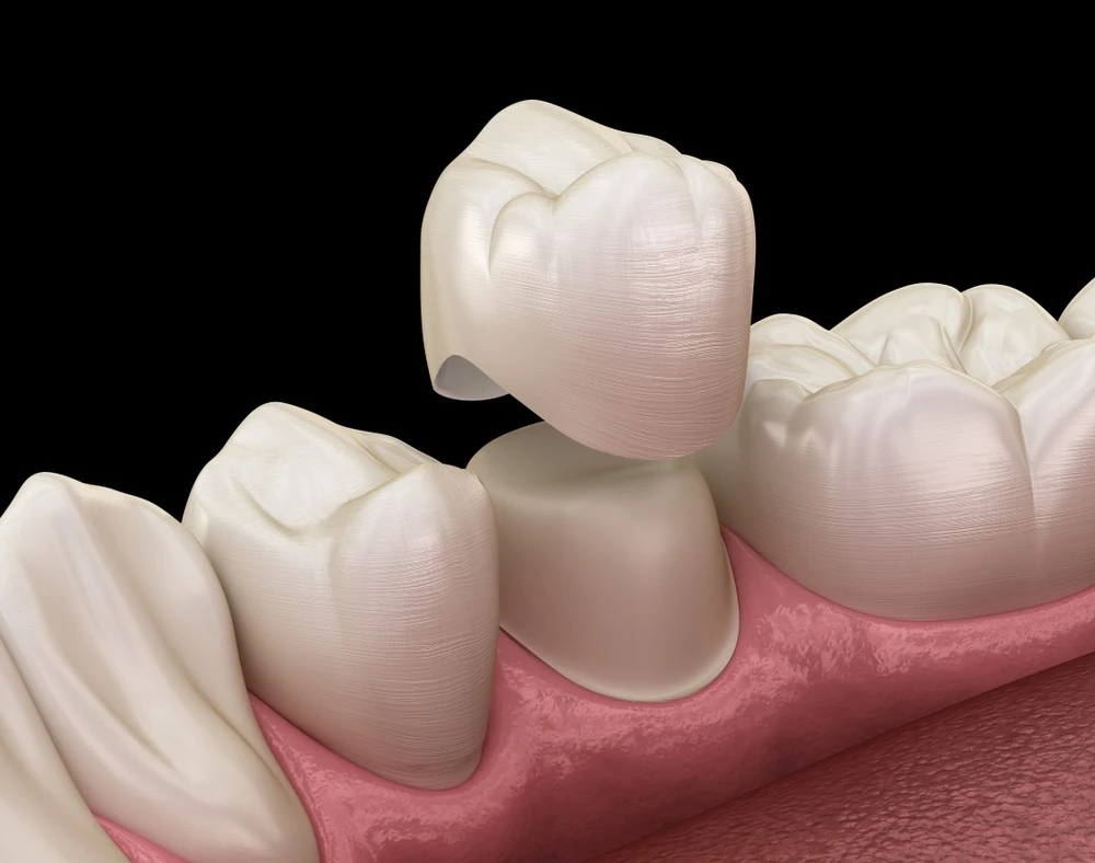 coronas-implantes-dentales-implantologia-dental-clinica-madrid-corbella