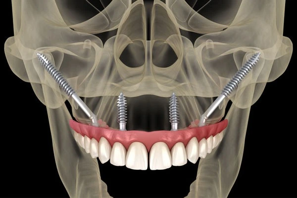implantes-cigomaticos-maxilar-superior