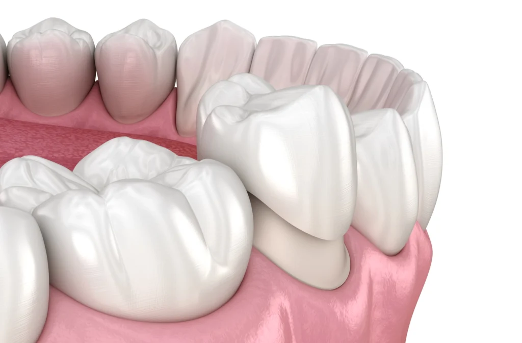 ¿Se puede quitar una corona dental y volver a poner? Casos y soluciones